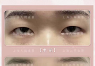 眼部整形美容,眼部整形美容全解析