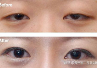 眼部整形项目,重塑明眸，焕发魅力风采